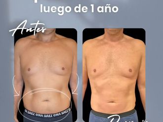 Lipoescultura antes y después - 877478