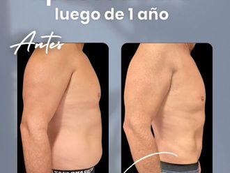 Lipoescultura antes y después - 877479