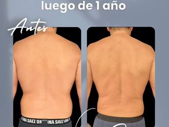 Lipoescultura antes y después - 877480