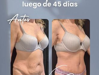 Dermolipectomía antes y después - 877481