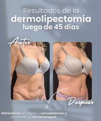 Dermolipectomia - Dr. Damián Wengrowicz