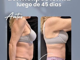 Dermolipectomía antes y después - 877482