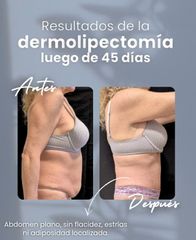 Dermolipectomia - Dr. Damián Wengrowicz