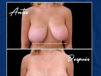 Reducción de mamas antes y después - 877483