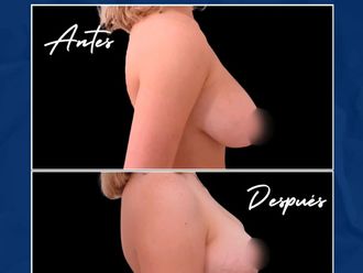 Reducción de mamas antes y después - 877484