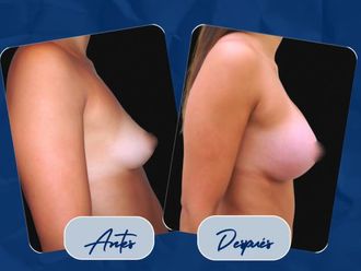 Aumento mamas antes y después - 877485