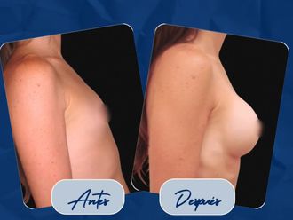 Aumento mamas antes y después - 877487