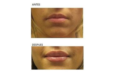 Labios