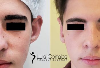 Otoplastia - Dr Luis Corrales