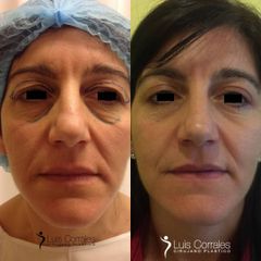 Blefaroplastia - Dr Luis Corrales