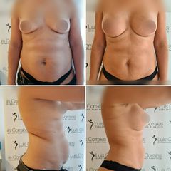 Abdominoplastia - Dr Luis Corrales