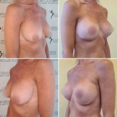 Mastopexia - Dr Luis Corrales