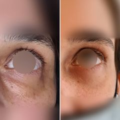 Eliminación de ojeras - Dr Luis Corrales