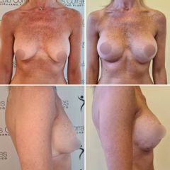 Mastopexia - Dr Luis Corrales