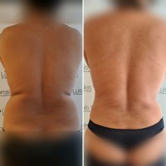 Liposucción - Dr Luis Corrales