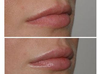 Relleno de labios con acido hialurónico