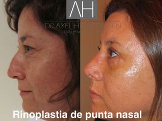 Rinoplastia