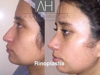 Rinoplastia