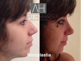 Rinoplastia