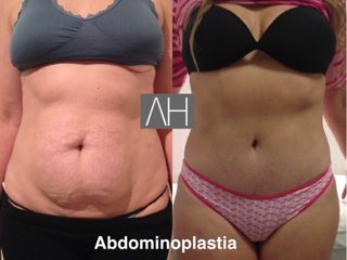 Abdominoplastia