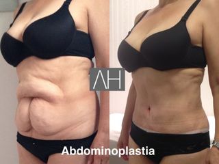 Abdominoplastia