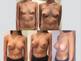 Aumento mamario Submuscular. Implante 300 perfil alto.