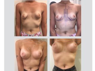 Aumento de Mamas: MAMAS TUBEROSAS