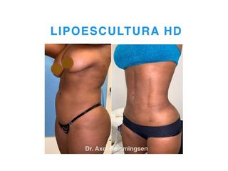 Lipoescultura