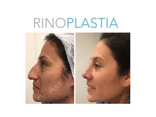 Rinoplastia