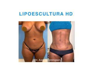 Lipoescultura