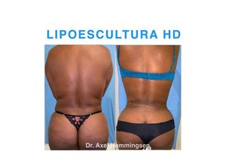 Lipoescultura