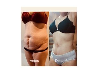 Abdominoplastía