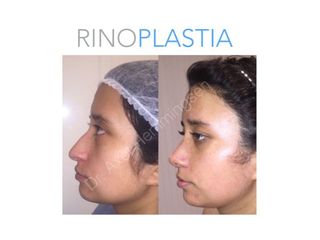 Rinoplastia