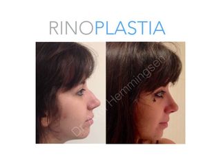 Rinoplastia