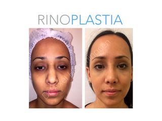 Rinoplastia