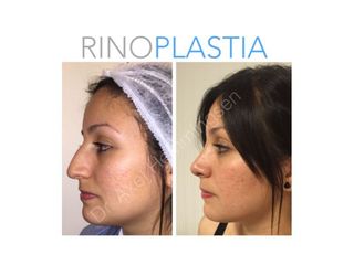 Rinoplastia