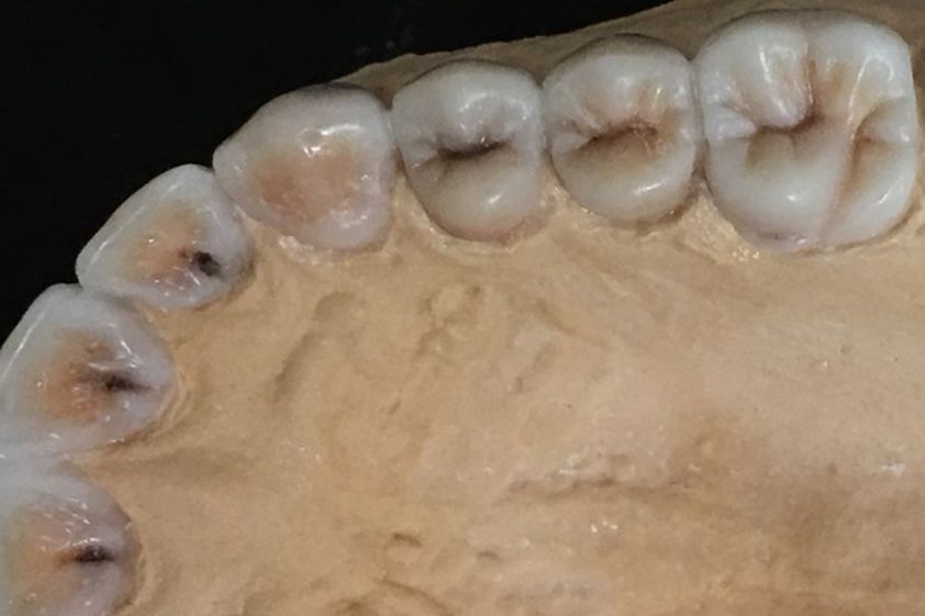 Prótesis dentales antes y después - 625819