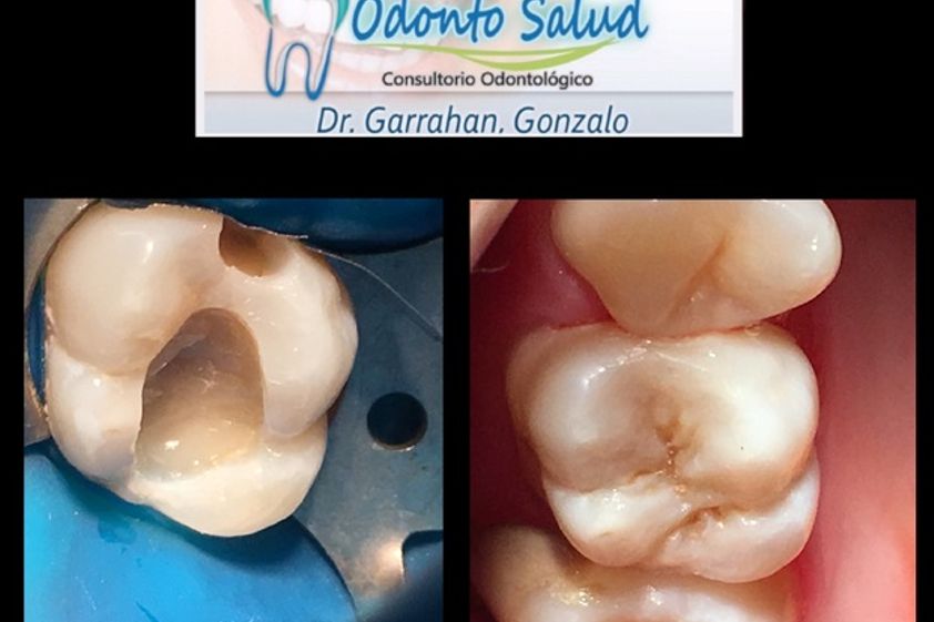 Periodoncia antes y después - 625821