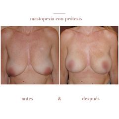 Mastopexia con Prótesis - Dr. Héctor Martínez Gomez