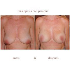 Mastopexia - Dr. Héctor Martínez Gomez