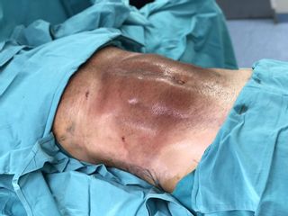 Resultado Inmediato Lipomarcación Másculina - Dr. Héctor Martínez Gomez