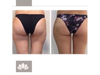 Celulitis - LASERMEDICALCORP