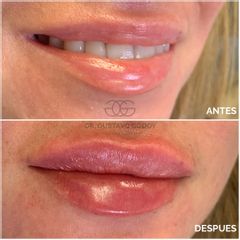 Relleno de labios - Dr. Gustavo Godoy