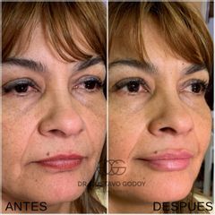 Relleno de labios con ácido hialurónico - Dr. Gustavo Godoy
