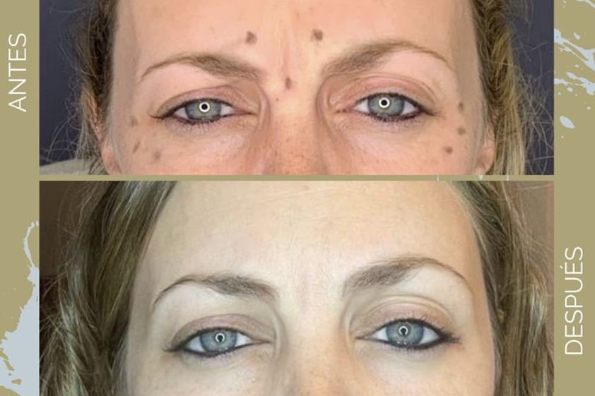 Botox antes y después - 841996