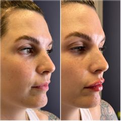 Relleno de labios - Dr. Gustavo Godoy