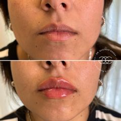 Relleno de labios - Dr. Gustavo Godoy