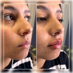 Relleno de labios - Dr. Gustavo Godoy