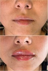 Relleno de labios - Dr. Gustavo Godoy