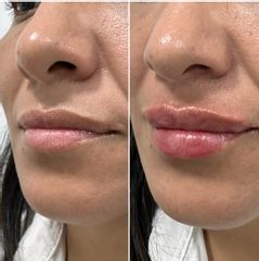 Relleno de labios - Dr. Gustavo Godoy